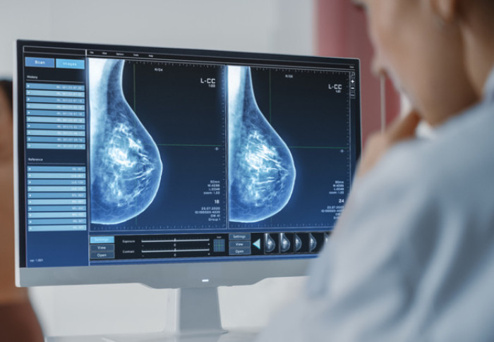 AI-assisted breast imaging at Sol Radiology
